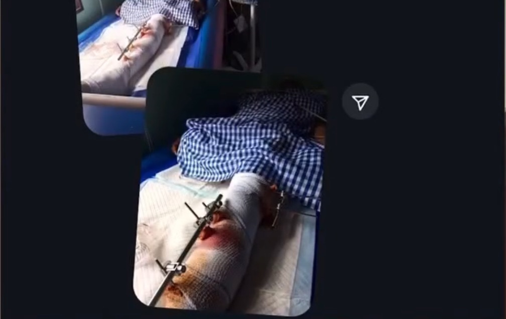 Dangote Truck Accident: BBNaija Star Phyna’s Sister Suffers Leg Amputation