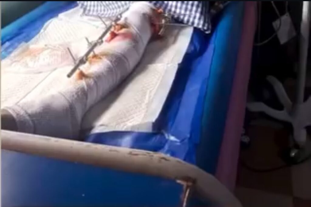 Dangote Truck Accident: BBNaija Star Phyna’s Sister Suffers Leg Amputation
